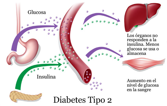 diagrama diabetes tipo ii